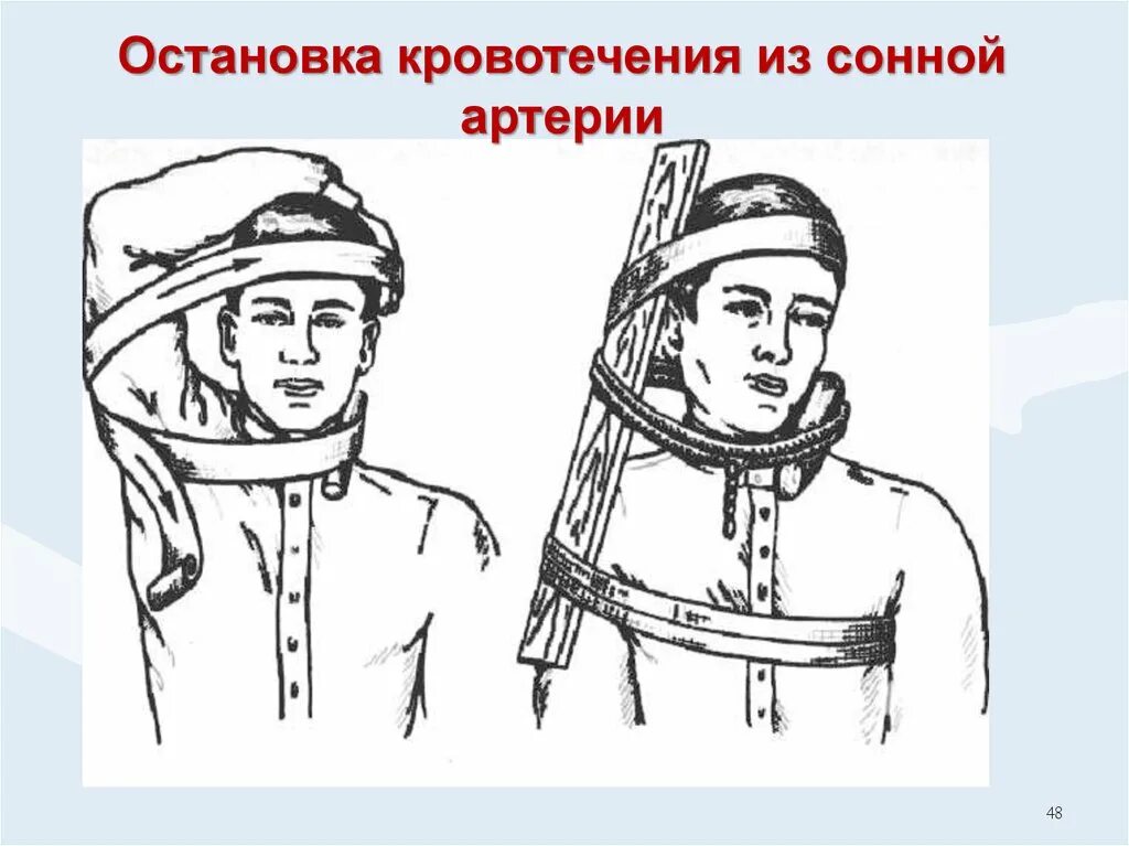 Остановить кровотечение на сонной артерии ответ тест. Алгоритм наложения жгута на шею при ранении сонной артерии. Остановка кровотечения на сонной артерии алгоритм. Способы временной остановки кровотечения при ранении сонной артерии. Метод Микулича остановка кровотечения.