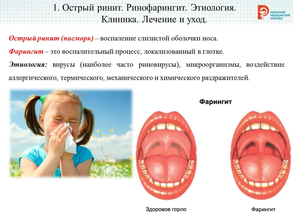 Что такое острый назофарингит