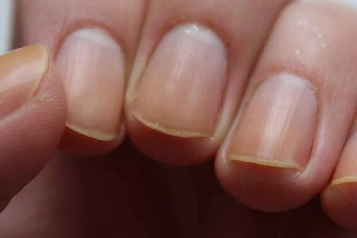 Ногти стали толстыми и твердыми. Ониходистрофия - онихолизис.. Тридерм онихолизис. Бактериальный онихолизис. Латеральный онихолизис.