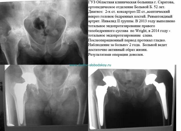 Дают инвалидность после замены сустава. Анкилоз тазобедренного сустава. ревматоидный артрит тазобедренного сустава. инвалидность после эндопротезирования тазобедренной. инвалидность после замены тазобедренного сустава.