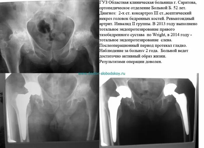 Анкилоз тазобедренного сустава. Ревматоидный артрит тазобедренного сустава. Инвалидность после эндопротезирования тазобедренной. Инвалидность после замены тазобедренного сустава.