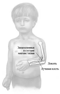 Подвывих головки