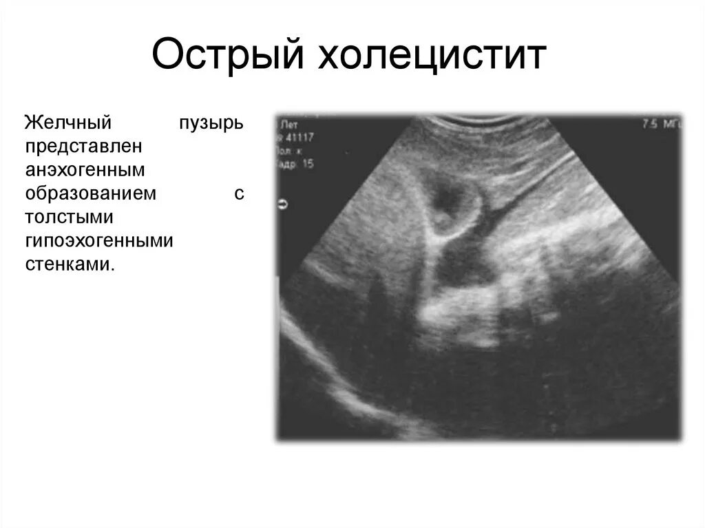 Эхопризнаки желчного пузыря. УЗИ желчного пузыря острый холецистит. Острый деструктивный холецистит УЗИ. Гипертонус желчного пузыря на УЗИ.