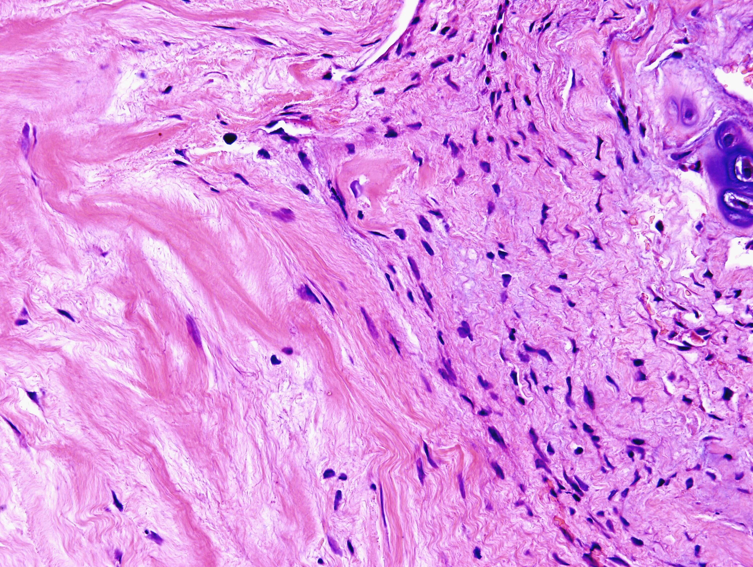 Серозная карцинома яичников гистология. Дисгормональная железистая гиперплазия эндометрия микропрепарат. Атипическая гиперплазия эндометрия гистология. Железистая гиперплазия эндометрия гистология. Атипическая гиперплазия эндометрия гистология.
