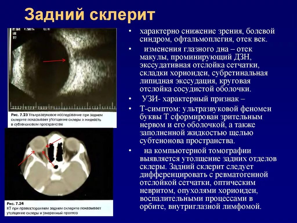 Задний склерит клинические проявления. Отслойка сосудистой оболочки УЗИ. Симптом, характерный для склерита. Отек зрительного нерва кт. Периневральное пространство зрительного нерва