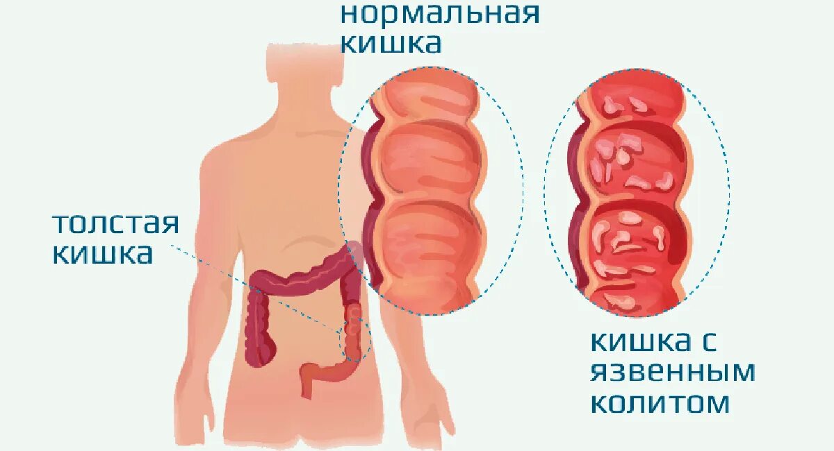 Симптомы хронического колита кишечника у взрослых. Язвенный колит кишечника. Хронический неспецифический язвенный колит. Язвенный колит картинки.