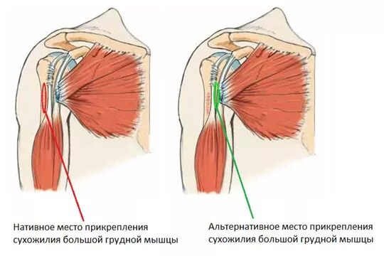 Отрыв сухожилия большой грудной мышцы. Реинсерция сухожилия грудной мышцы. Операция на сухожилие грудной мышцы. Разрыв сухожилия грудной мышцы.