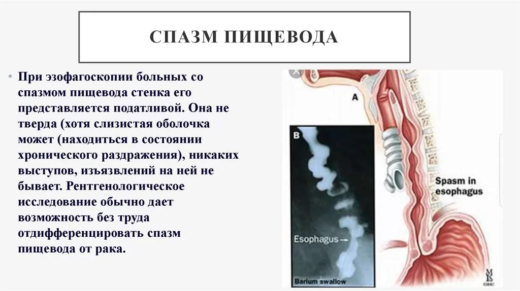 Ком в пищеводе причины. Спастические сокращения пищевода. Диффузный спазм пищевода. Эзофагоспазм симптомы.