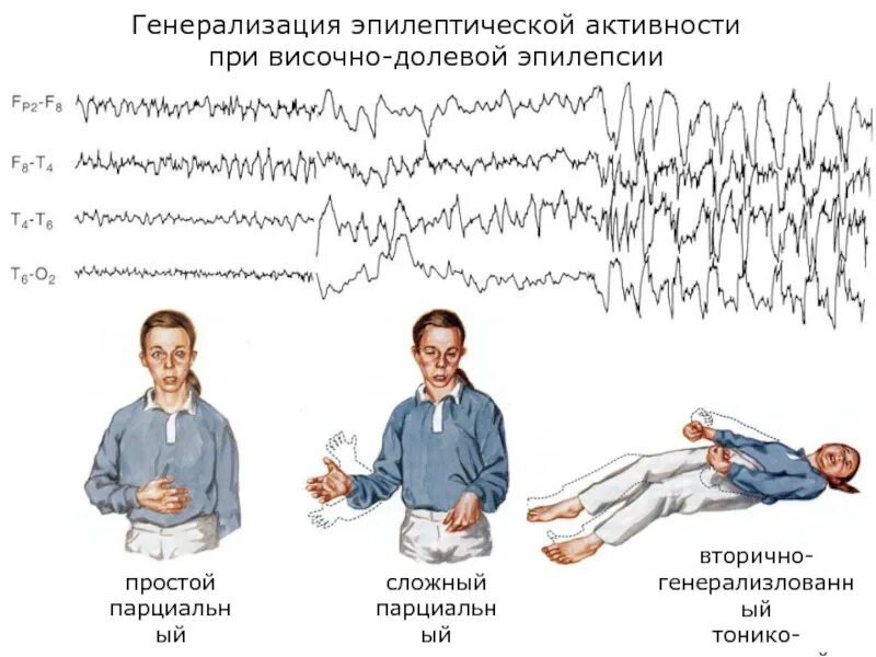 От чего может быть эпилепсия. Парциальные эпилептические приступы. парциальные и генерализованные эпилептические припадки. приступ эпилепсии симптомы. парциальная эпилепсия.