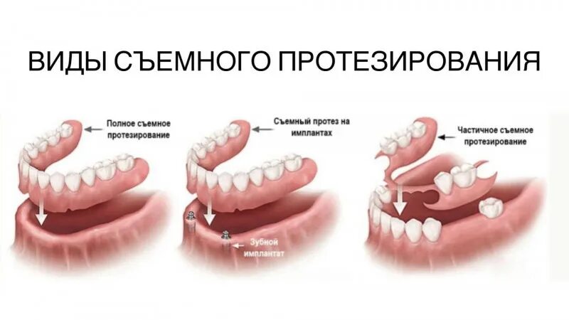 Как долго привыкать к съемным зубным протезам