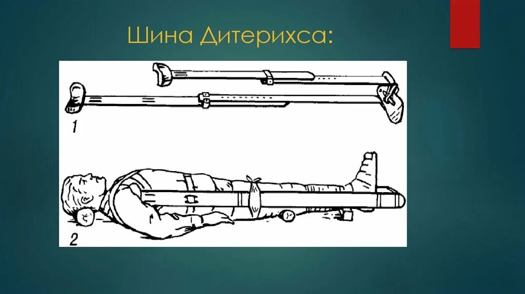 Крамера дитерихса. Транспортная иммобилизация шиной дитерихса. шина крамера и дитерихса. стандартными шинами крамера-дитерихса. шина дитерихса и шина крамера.