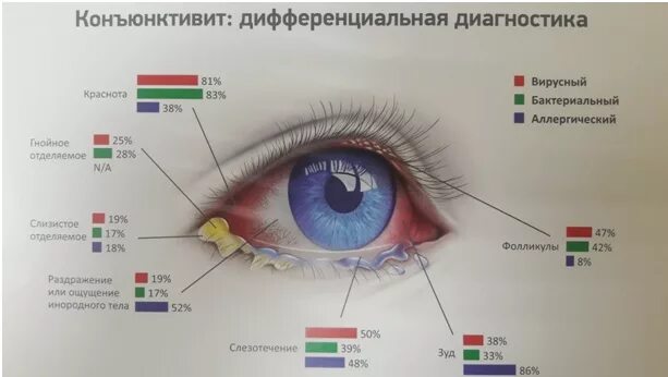 Вирусный фолликулярный конъюнктивит. Дифференциальный диагноз конъюнктивитов. Диф диагностика конъюнктивитов. Фолликулез конъюнктивы век.