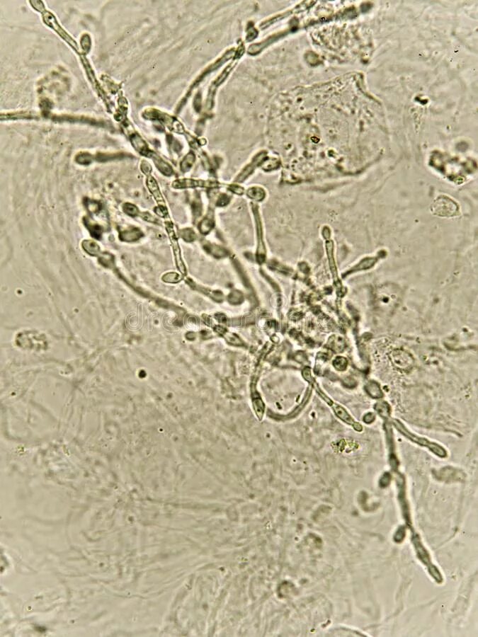 Дрожжевые клетки в моче повышены. Грибы кандида микроскопия. Псевдомицелий кандида. Candida albicans в нативном препарате.
