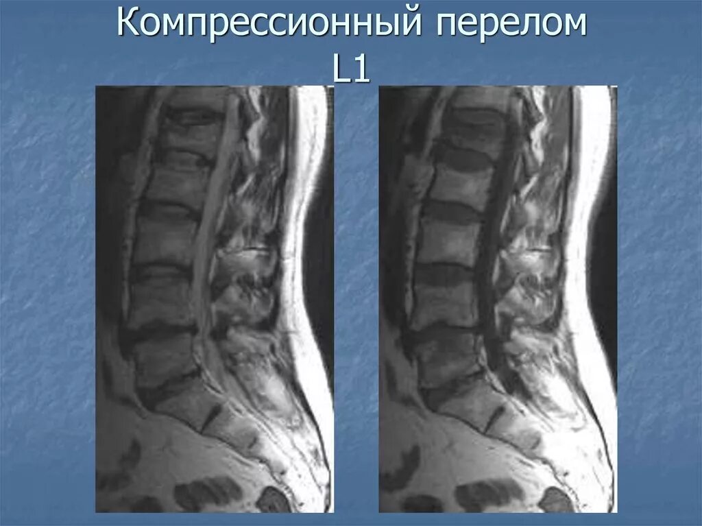 Компрессионный перелом позвонков l3 l4. Компрессионный перелом позвоночника th11-l1. Компрессионный перелом th1 кт. Консолидирующийся компрессионный перелом th12 позвонка 2ст.