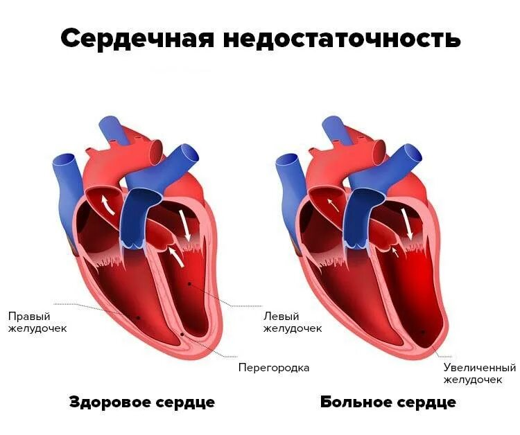 Дополнительная трабекула левого желудочка. Дополнительная трабекула левого желудочка сердца. Диагональная трабекула сердца. Диагональная трабекула левого желудочка.