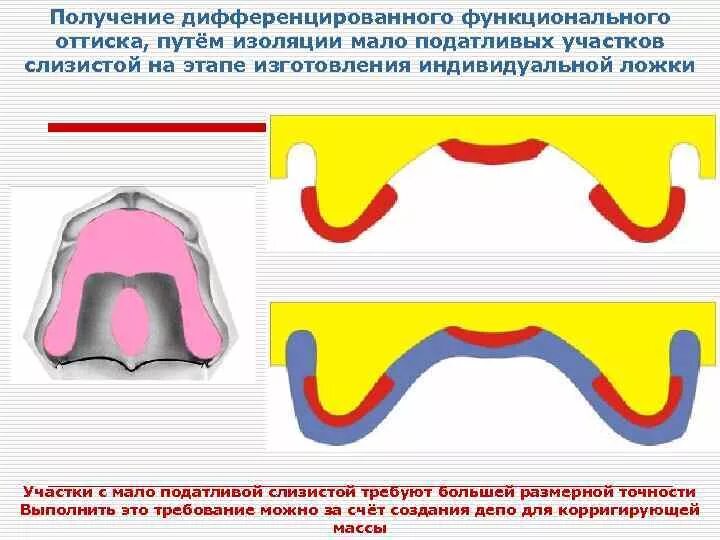 Зона податливости слизистой оболочки. Этапы изготовления индивидуальной ложки. Податливость слизистой оболочки. Лабораторные этапы изготовления индивидуальных ложек. Дифференцированное снятие оттиска.