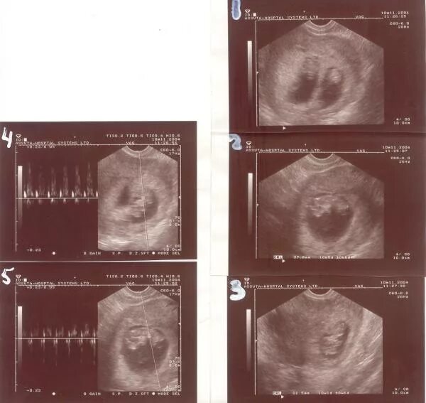 УЗИ 8 недель беременности двойня.