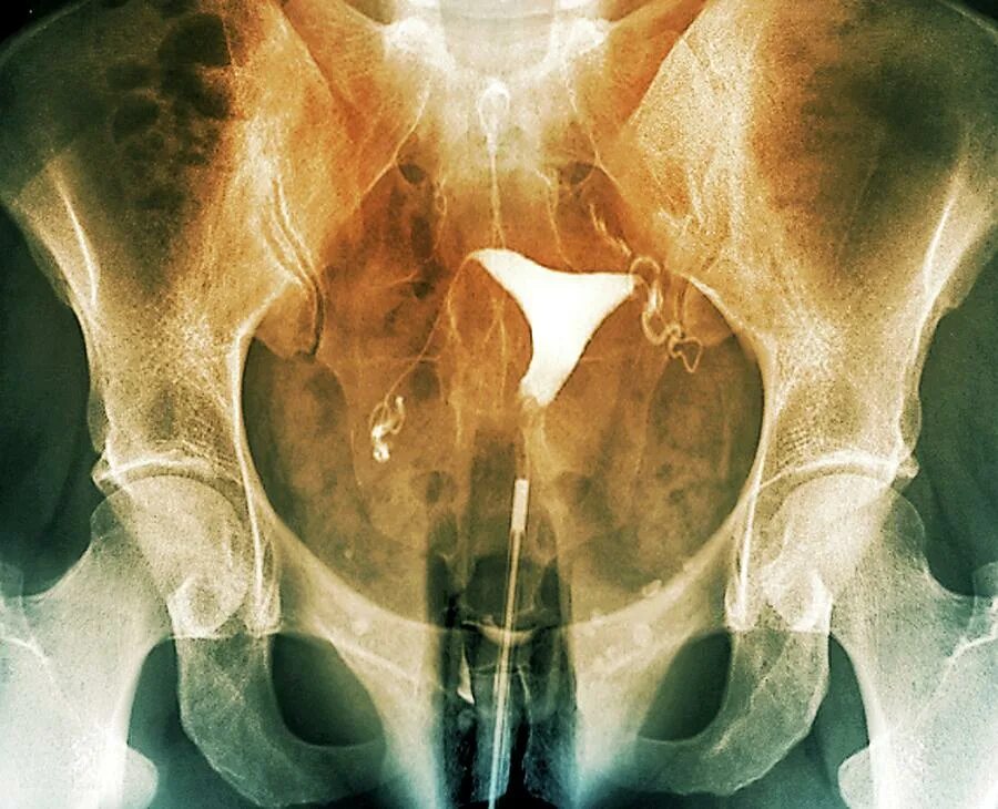 красивая матка. анатомия человека в цветах. два женских органах. два женских органах. красивая матка.