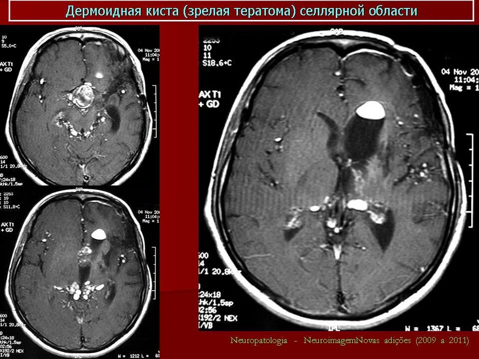 Киста головного мозга последствия. Дермоидные кисты головного мозга мрт. Дермоидная киста головного мозга кт. Дермоид головного мозга кт.