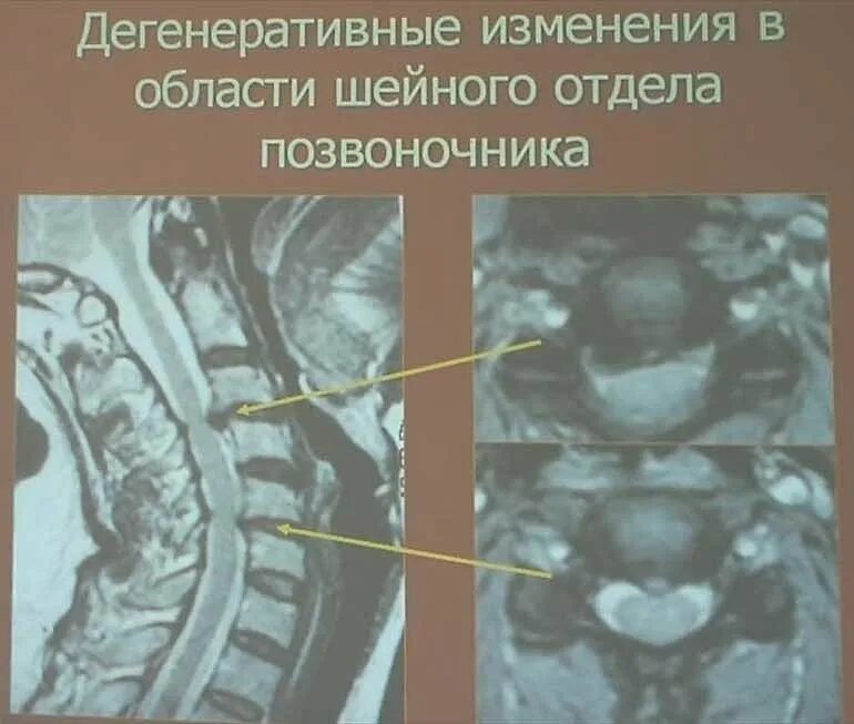 Начальные дистрофические изменения крестцово