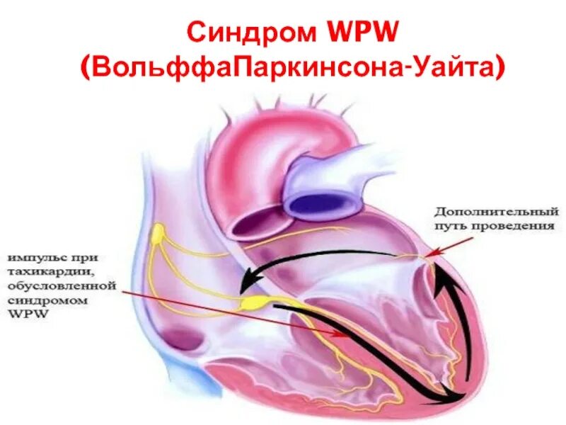 Синдром вольфа уайта. Признаки впв. wpw синдром механизм развития. болезнь сердца синдром впв. синдром преждевременного возбуждения желудочков wpw.