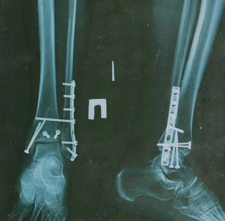 Остеосинтез трехлодыжечный перелом. Остеосинтез межберцового синдесмоза. Остеосинтез заднего края большеберцовой кости винтом. Репозиционный остеосинтез. Остеосинтез операция пластины