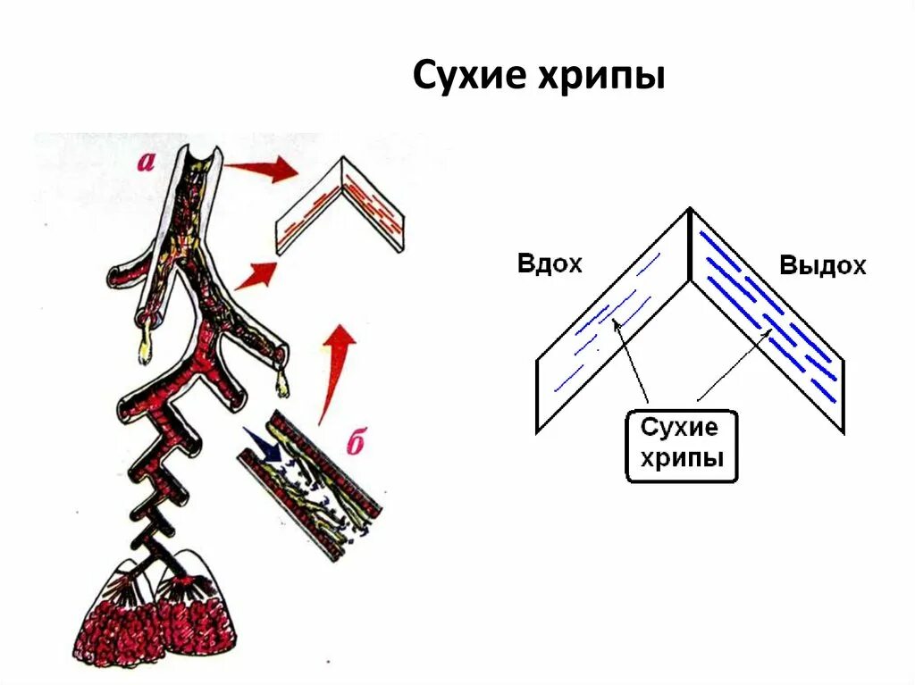 Звонкие хрипы. Сухие свистящие хрипы. Механизм образования сухих и влажных хрипов. Сухие хрипы виды. Механизм хрипов.