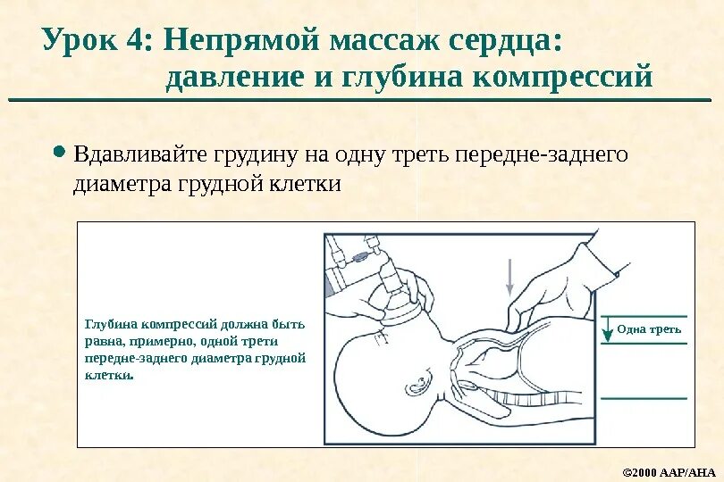 Частота закрытого массажа сердца. Глубина смещения грудины при непрямом массаже сердца. Рекомендуемая глубина при проведении непрямого массажа сердца. Непрямой массаж сердца глубина продавливания грудной клетки. При непрямом массаже сердца глубина продавливания.