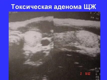 Аденома щитовидной железы удаление