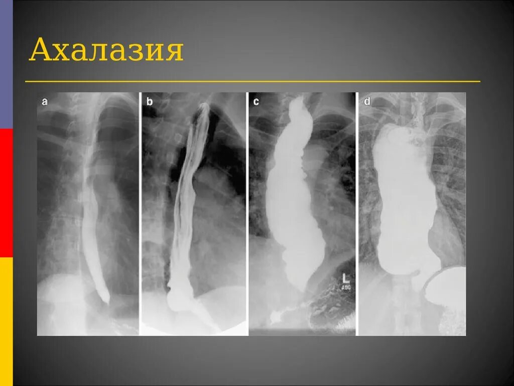 Диффузная пищевода. Ахалазия кардии пищевода рентген. Рентген халащия пищевода. Ахалазия кардии и кардиоспазм. Кардиоспазм и ахалазия пищевода рентген.