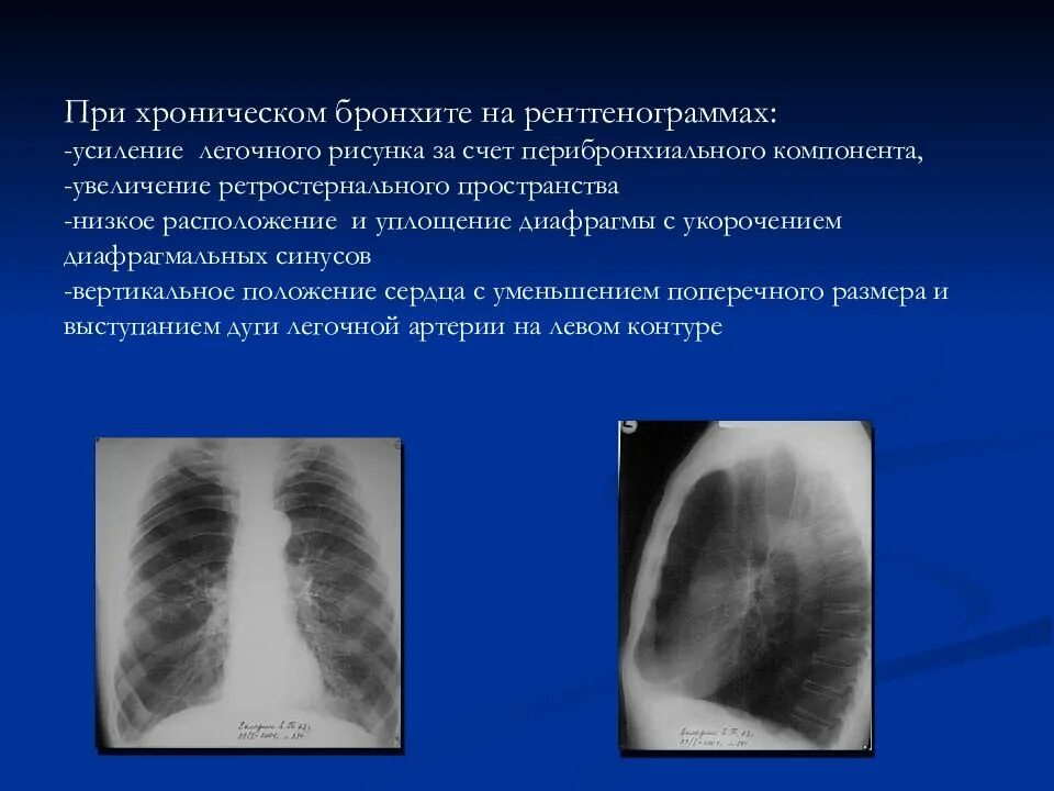 Рентген критерии хронического бронхита. Хронический бронхит на рентгене описание. Рентгенография при хроническом бронхите описание. Описание рентгена грудной клетки при бронхите.