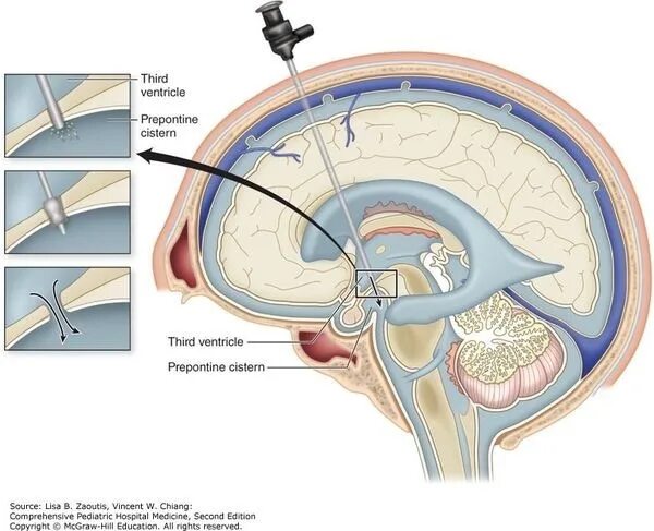 Расширенные ликворные пространства. Эндоскопическая вентрикулостомия III желудочка. Наружное дренирование желудочков мозга. Эндоскопическая вентрикулоцистерностомия. Эндоскопический вентрикулостомия дна 3 желудочка головного мозга.