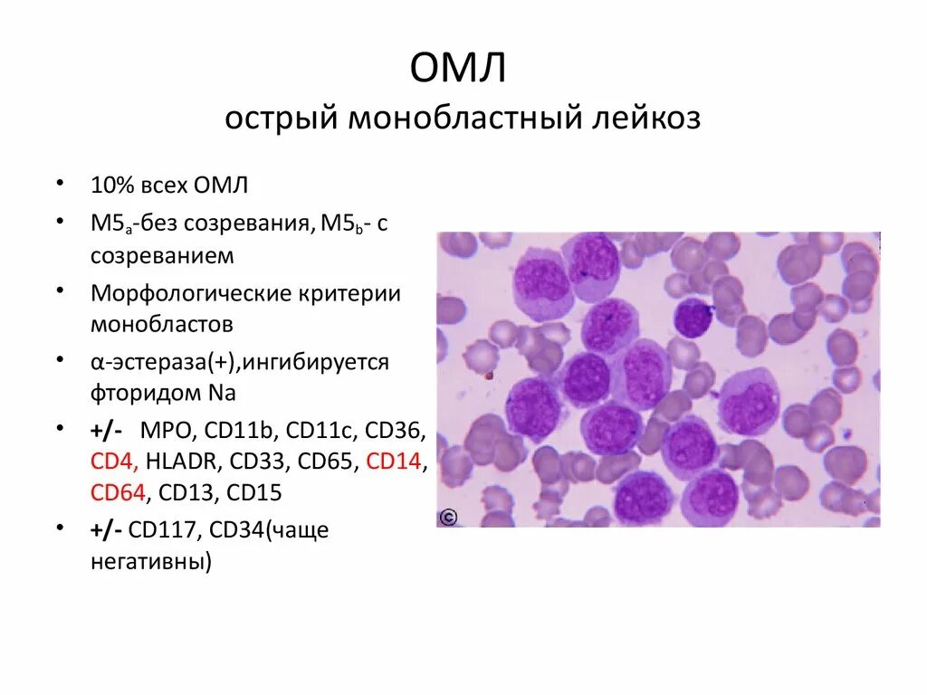 Мозг при остром лейкозе. Острый миелобластный лейуозкартина крови. Острый моноцитарный лейкоз картина крови. Хронический миеломоноцитарный лейкоз картина крови. Острый миелобластный лейкоз картина.