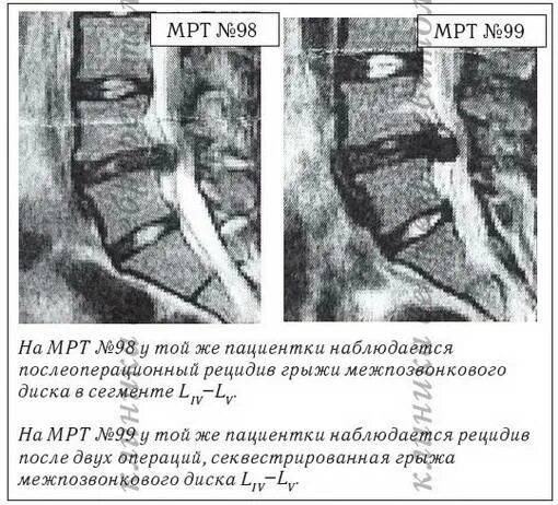 Рецидив грыжи позвоночника на кт картинки. Грыжа межпозвоночного диска мрт. Рецидив грыжи межпозвоночного диска. Секвестрированная грыжа l5-s1. Бифораминальный субстеноз.