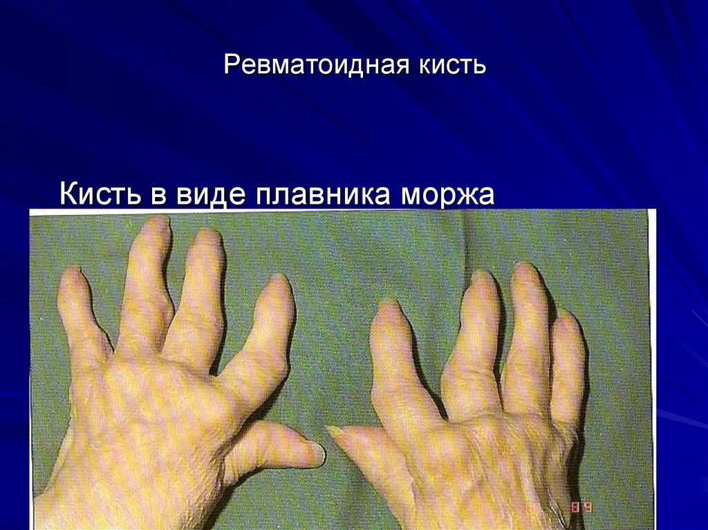 Деформации кисти при артритах. Ревматоидный артрит ласта морда. ульнарная девиация в суставах кистей. кисти с ревматоидным артритом бутоньерка. ревматоидный артрит деформация кисти.