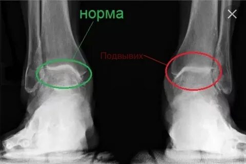 Отек медиальной лодыжки