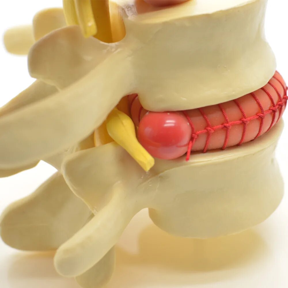 Межпозвонковая грыжа поясничного отдела лечение. Межпозвоночная грыжа. Межпозвонковая грыжа поясничного. Междисковая грыжа позвоночника. Грыжа межпозвонкового диска.