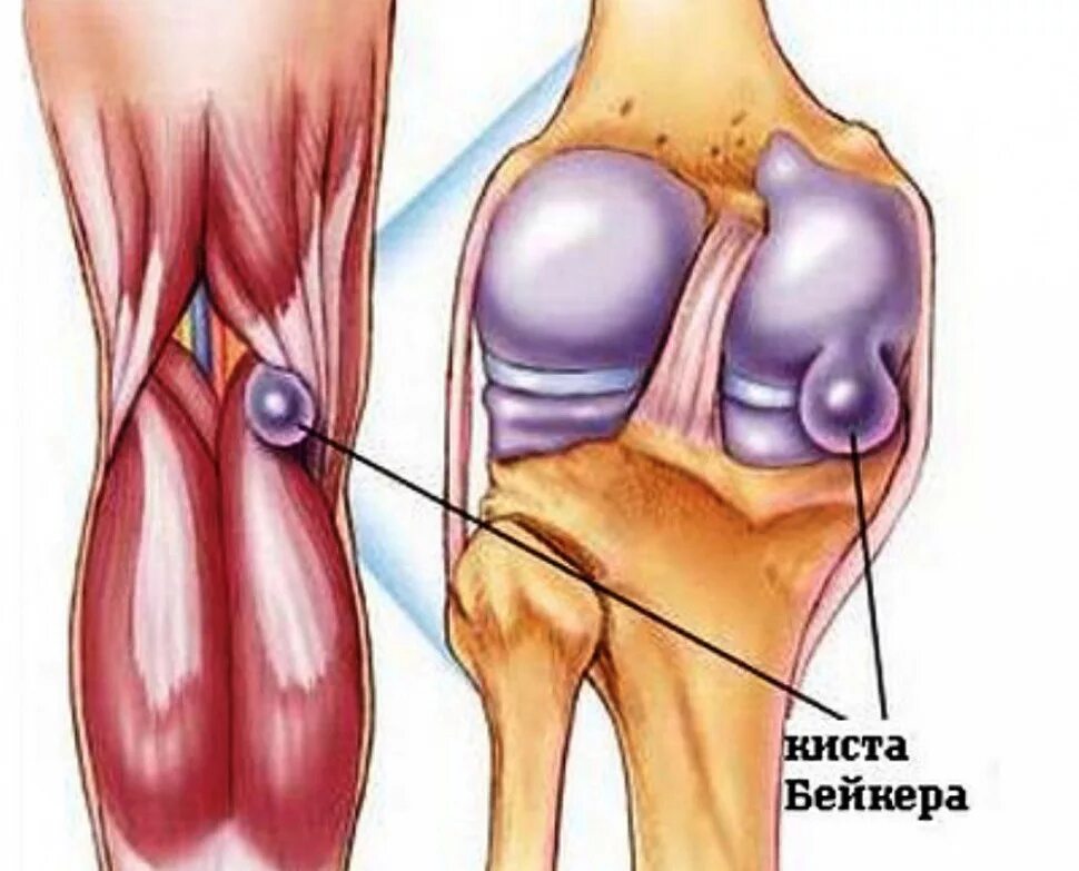 Болит под коленкой. Препателлярный бурсит. Ганглиевая киста коленного сустава. Заднелатеральная киста Бейкера. Киста Бейкера на УЗИ коленного сустава.