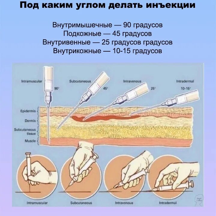 Под каким углом делать укол. Подкожная и внутрикожная инъекция. Внутрикожная инъекция градус. Угол введения иглы при внутривенном введении.