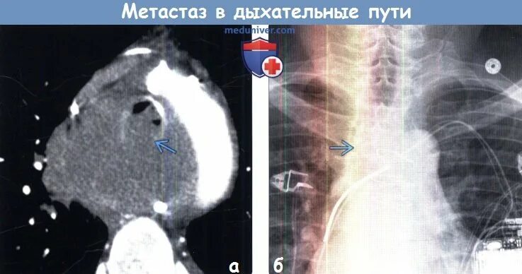 Что такое метастазы и как. Как выглядят метастазы на рентгене.