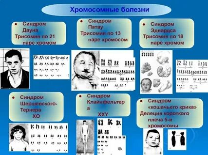 Трисомия 2 пары хромосом