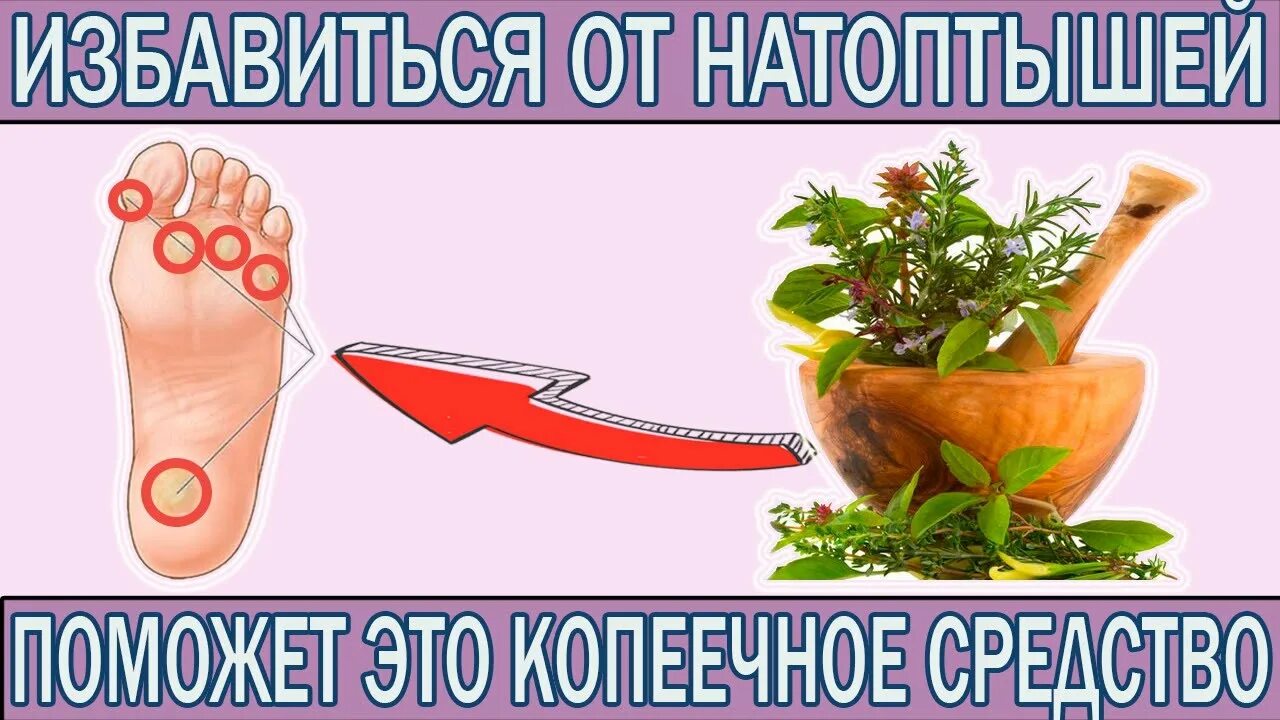 Народные средства от натоптышей. Избавляемся от натоптышей на ногах. Средства от натоптышей на стопе. Народные средства от натоптышей на ступне ноги.