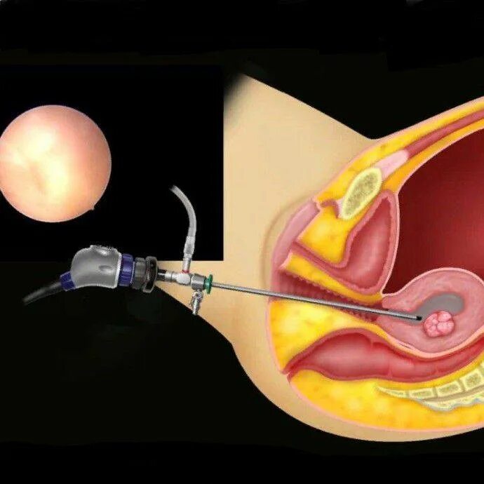 Гистероскопия полипэктомия. Операция гистерорезектоскопия. Гистерорезектоскопия (резектоскопия). Гистерорезектоскопия полипа матки.