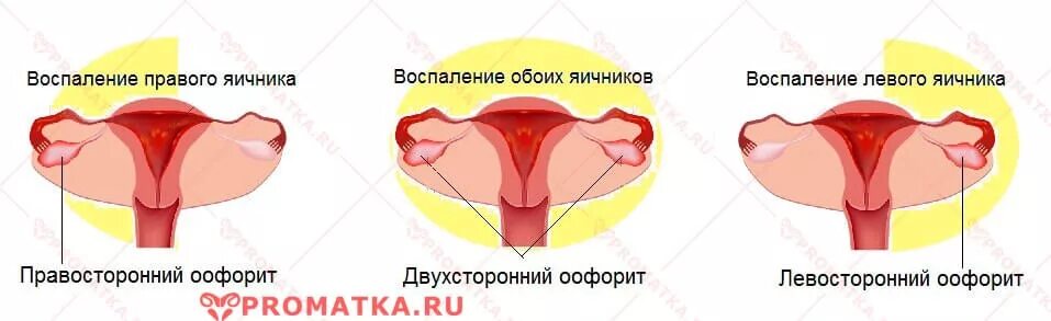 Оофорит что это. Оофорит классификация. Оофорит что это. Эхограмма сальпингоофорит. Сальпингоофорит апоплексия.