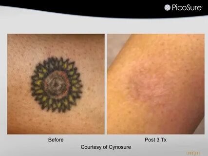 Picosure отзывы удаление