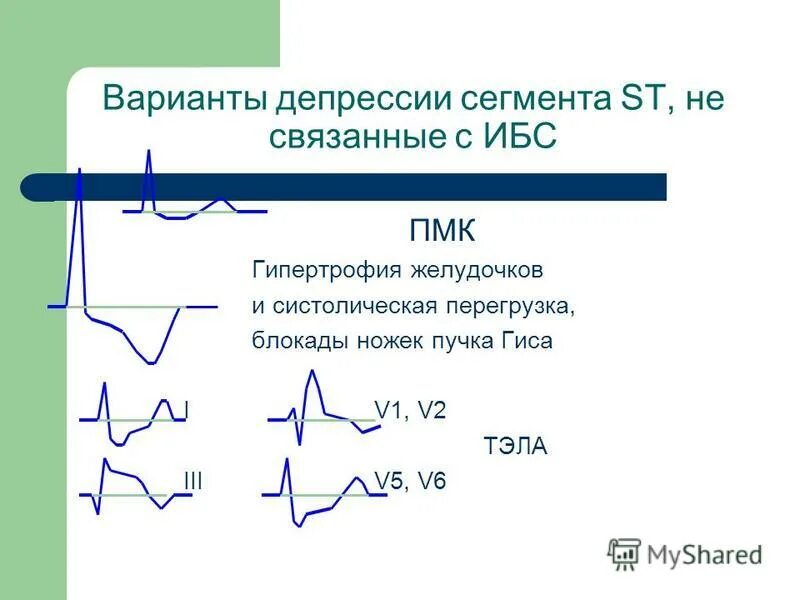 Депрессия сегмента st. VJ;TN KB ,SNM B ,kjrf;LF YJ;tr GEXRF UBCNF B ubgthnhjabz ;tkeljxrf.