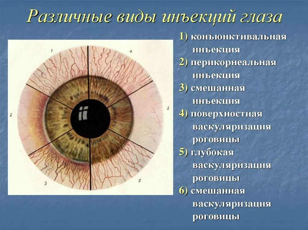 Особенность строения радужки какую функцию она выполняет. Инъекция склер и конъюнктивы. Расширение сосудов конъюнктивы склеры. Инъекция сосудов конъюнктивы.