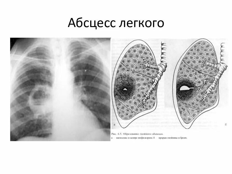 Дренированный абсцесс легкого. Хронический абсцесс легкого рентгенограмма. Абсцесс легкого рентген. Острый абсцесс легкого рентген. 1 абсцесс легкого