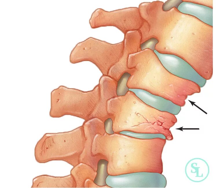 Компрессионный перелом позвонков l3 l4. Компрессионный перелом позвоночника грудного отдела. Компрессионный перелом 6 позвонка. Компрессионный перелом 12 грудного позвонка. Компрессионная операция на позвоночнике