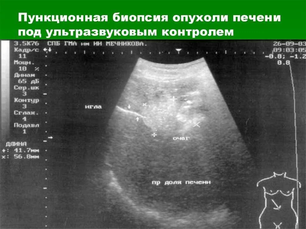 Тонкоигольная аспирационная биопсия печени. Чрескожная биопсия печени. Пунктуауионная биопсия печени. Биопсия печени под контролем УЗИ.